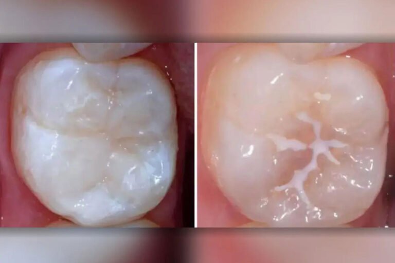 Pit and Fissure Sealants